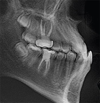Class III Treatment in 15 Months Check out how Dr. Alan Curtis treated a 16-year-old patient who presented with maxillary square archform, mandibular spacing and a protrusive habitual bite with condyles forward of CR.