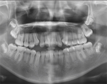 Treatment of Open-Bite with Mini-Screws and Segmental Mechanics Often one of the most challenging malocclusions for clinicians to treat, the open-bite is examined from diagnosis through treatment in this in-depth case presentation from Dr. Edmund Khoo.