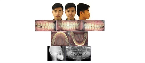 Townie Treatment Case: Small But Mighty Dr. Adith Venugopal shares a case study in which he used extraradicular miniscrews to encourage tooth movement during whole-arch distalization to help correct lip incompetence and bidental protrusion.