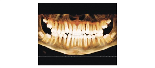 CE: Phase I Treatment Dr. Daniel J. Grob explains how, if patients are treated early, the interception of oral habits and medical conditions can make orthodontic correction easier and more successful later. Grob shares multiple cases that illustrate these principles at work. 
