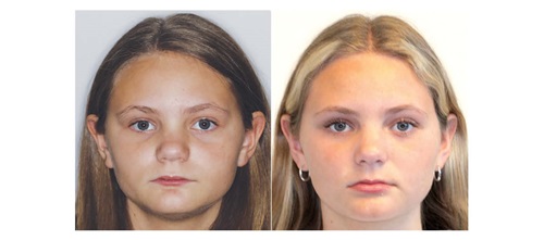 ‘Short-Face’ Patients—Part 3 Orthotown Editorial Director Dr. Chad Foster continues his four-part series on treatment considerations for patients whose faces have short lower thirds.