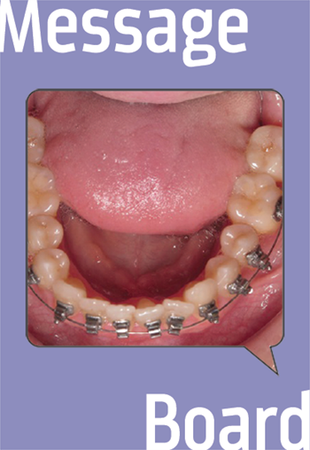Clinical Orthodontics: 16 Months In and Lower Incisors Won’t Align What do you do when you don’t see results as soon as you would like?