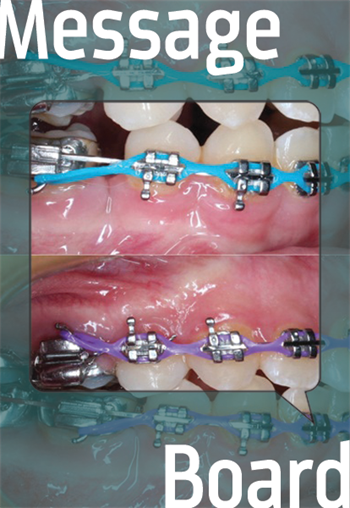 Clinical Orthodontics: Cr-Co Shift We don’t hear too much about Cr-Co these days. Some good considerations on finishing are offered.