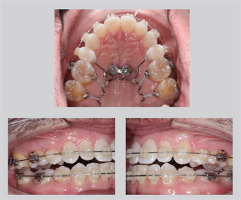 Use of the Multi-Tooth Intruder for Maxillary Posterior Intrusion and Torque Control Dr. Alexander Waldman shares case studies using his new “multi-tooth intruder” skeletal anchorage tool, which can be paired with either traditional braces or aligners.