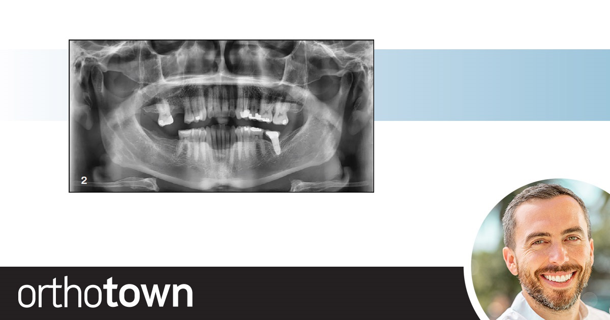 Aligners and Planned Implants Dr. Ryan McComb shares a case in which he collaborated with the patient’s dentist to formulate a treatment plan that would help a patient with aesthetic challenges and still save space for a pair of planned implants.