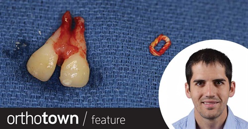 Case Study: Patient-Placed Elastic Forces Tooth Extraction Dr. Michael Daetwyler, a surgeon in the oral and maxillofacial surgery clinic at UCSF Fresno, shares a case in which a young patient’s severe bone loss, tooth mobility and soft-tissue lesion were caused by an unexpected factor.
