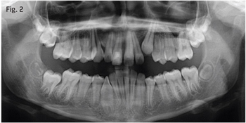 Herbst Fixed Functional Treatment for a Severe Class II Thinking of retiring the Herbst appliance? Dr. William Gierie presents an argument for keeping it in your arsenal, and demonstrates its effectiveness in this Class II case presentation. 