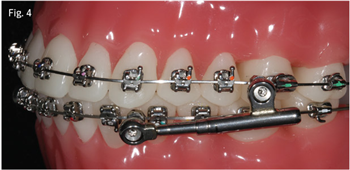 Simplified Correction of Class II Using PowerScope Dr. Alexandre Moro outlines how this intermaxillary Class II corrector appliance offers simplified installation and increases patient comfort.