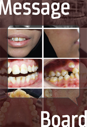 Adult with Impacted Canines A Townie shares a complex case that requires many steps to correct.