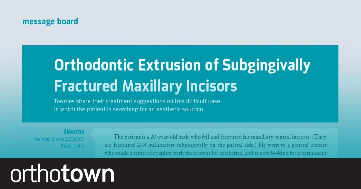 Orthodontic Extrusion of Subgingivally Fractured  Maxillary Incisors Townies share their treatment suggestions on this difficult case in which the patient is searching for an aesthetic solution.