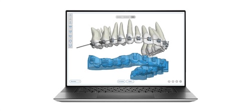 Earned Placement: Digital Indirect Bonding Advancing speed and precision in orthodontic treatment with Dibs AI