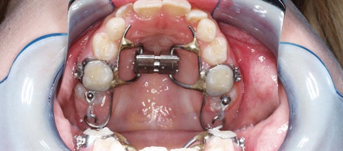 Case Study: Hyrax-Halterman Appliance A case study from Dr. Chris Teeters discusses his use and manipulation of the Hyrax-Halterman device.