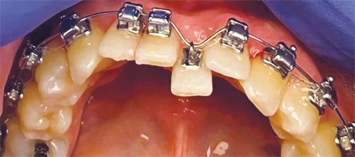 A Voice in the Arena: Eyelets–The Magic Bracket Editorial Director Dr. Chad Foster explains the biomechanics behind eyelets—how they harness
superelastic NiTi wires for optimal force delivery and efficient tooth movement.