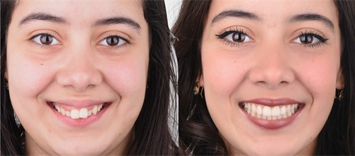 Occlusal Plane Control Dr. Wassim Bouzid explores the critical role of occlusal plane control in treating Class II high-angle malocclusions.
