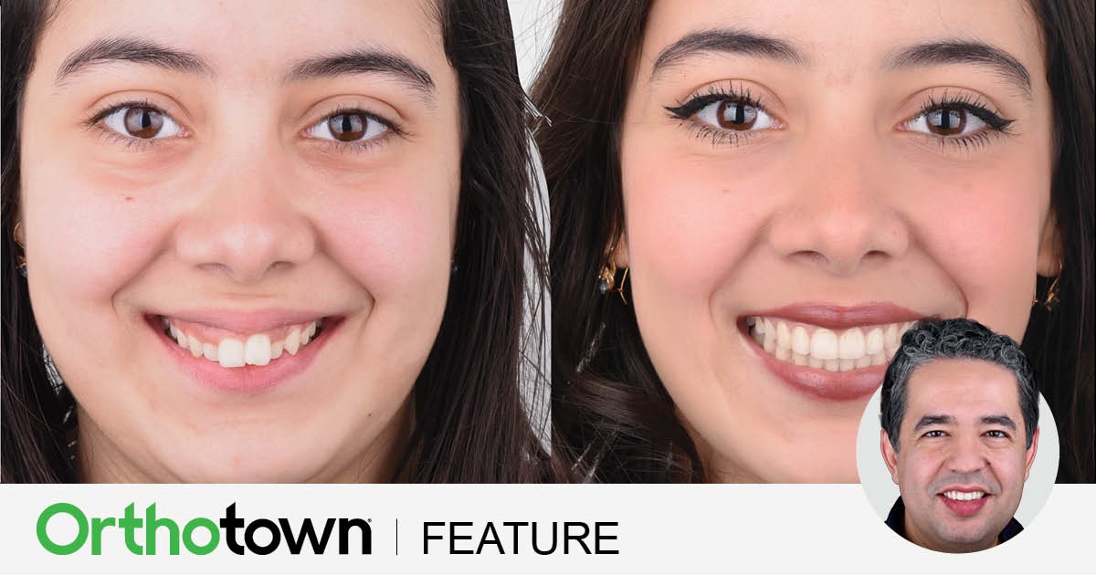Occlusal Plane Control