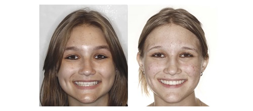 ‘Short-Face’ Patients—Part 4 Dr. Chad Foster concludes his four-part series, exploring treatment strategies for “short-face” patients and the transformative impact of vertical changes in orthodontics.