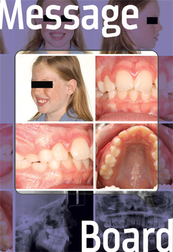 Treatment Approach A doc shares a case involving a young girl in the mixed dentition and seeks advice on how to approach treatment.