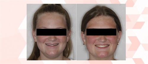 A Voice in the Arena: Aesthetic Importance of Upper Incisor Vertical Position Orthotown Editorial Director Dr. Chad Foster shares a patient case in which the position of upper incisors within the lip frame became of singular importance during treatment.