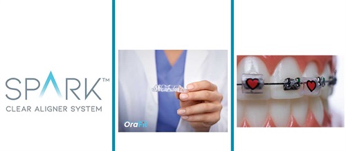 New Products Take a look at some of the newest products hitting the orthodontic market.