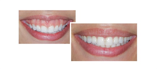 Townie Treatment Case: Gummy Smile Treatment With Aligners Although gummy smiles are usually treated using TADs and braces, Orthotown editorial board member Dr. Trevor Nichols shares a case in which he successfully treated a patient using TADs and clear aligners.