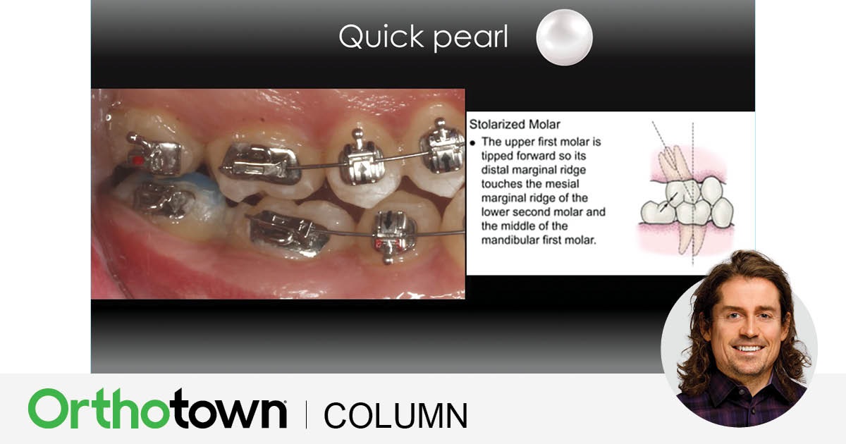 A Voice in the Arena: Simple but Powerful Editorial director Dr. Chad Foster shares a technique for proper
positioning of maxillary molar tubes.