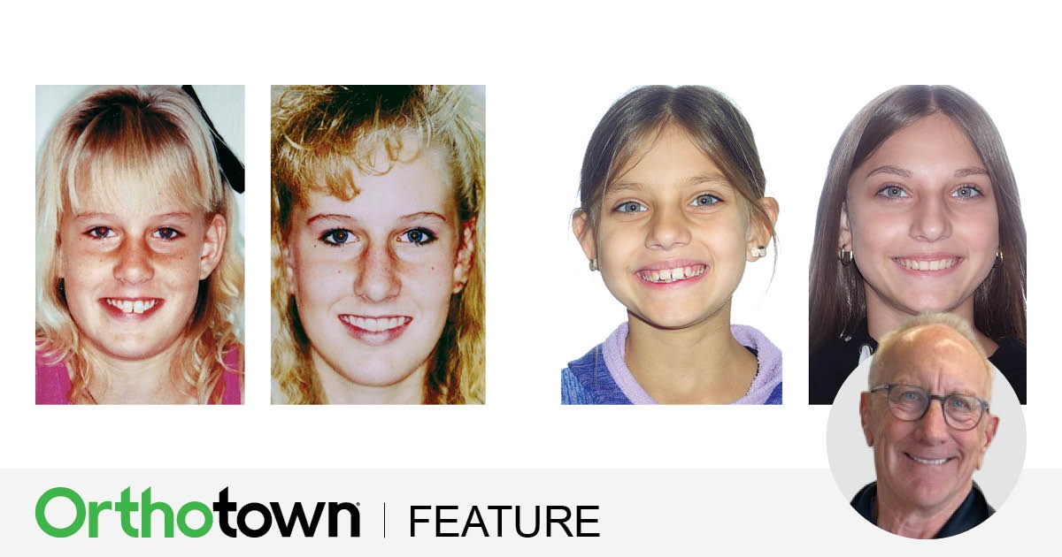 A Tale of Two Cases Dr. Daniel J. Grob reflects on 40 years of
orthodontic evolution, comparing past and
present treatment approaches for Class II
malocclusions through real case studies.