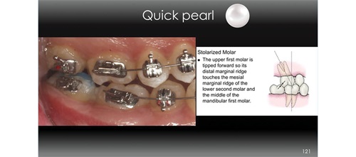 A Voice in the Arena: Simple but Powerful Editorial director Dr. Chad Foster shares a technique for proper
positioning of maxillary molar tubes.