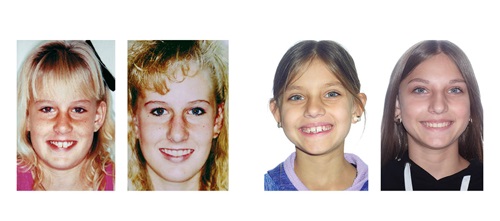 A Tale of Two Cases Dr. Daniel J. Grob reflects on 40 years of
orthodontic evolution, comparing past and
present treatment approaches for Class II
malocclusions through real case studies.