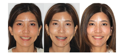 Shifting Smiles and Perspectives Dr. Bhudsadee Ying Saenghirunvattana
showcases a non-surgical approach to correcting
occlusal cant using TADs, offering an effective
alternative for complex orthodontic cases.