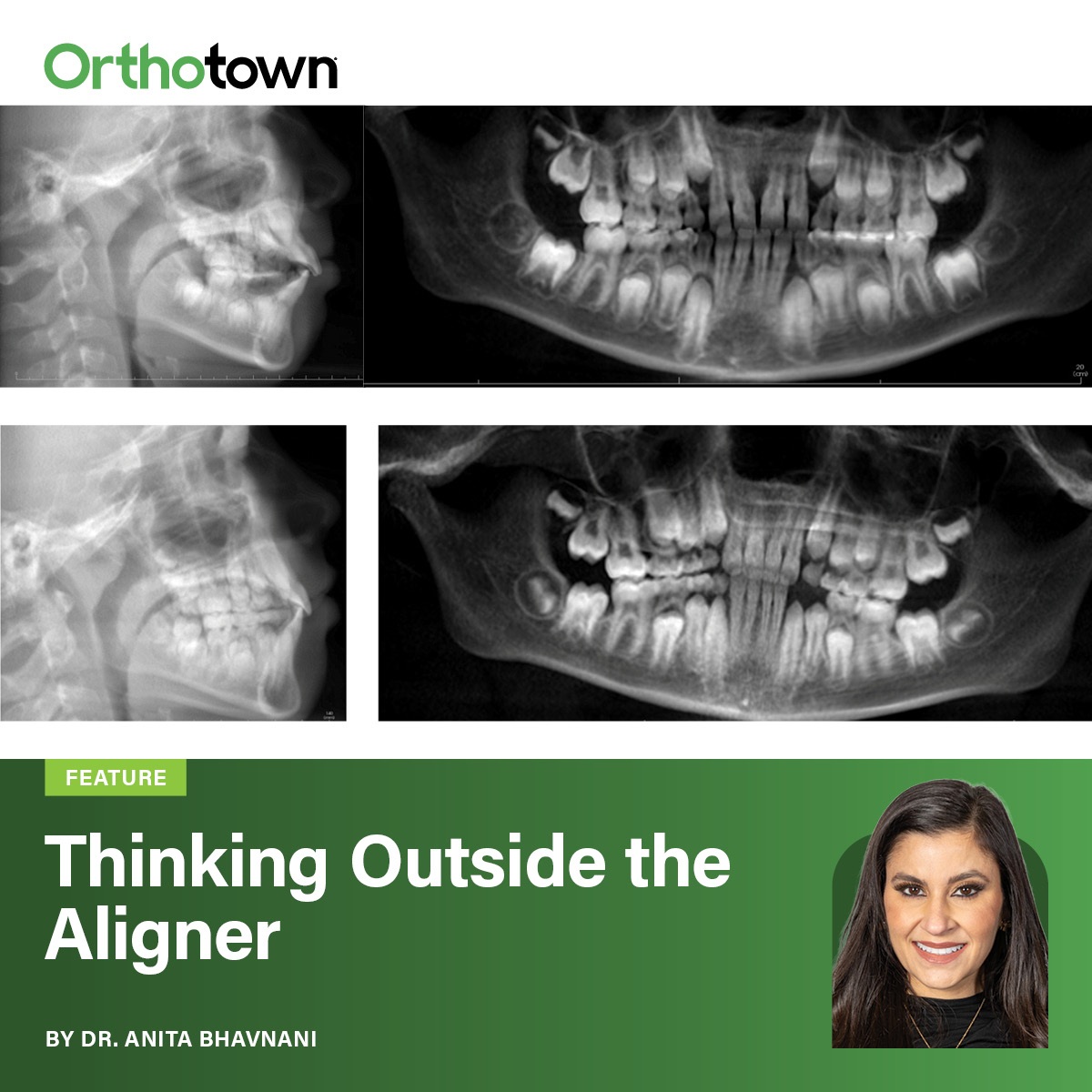 Thinking Outside the Aligner