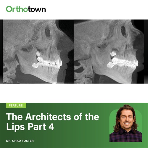 The Architects of the Lips: Part 4 Dr. Chad Foster presents a case where modest incisor proclination improved both lip aesthetics and smile projection for a retrognathic patient with thin lips.