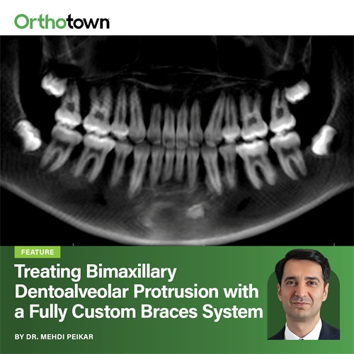 Treating Bimaxillary Dentoalveolar Protrusion with a Fully Custom Braces System Dr. Mehdi Peikar presents a 16-month extraction case using the Celebrace system, demonstrating how custom bracket prescriptions supported precise incisor retraction and improved facial balance.