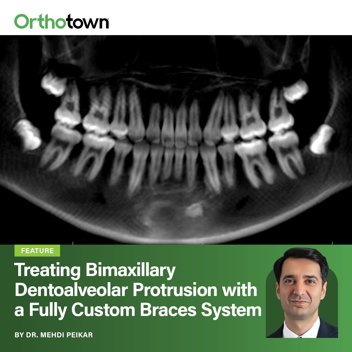 Treating Bimaxillary Dentoalveolar Protrusion with a Fully Custom Braces System