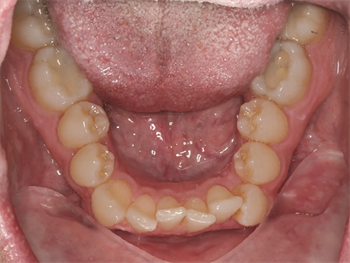 Make Mine a Combo For some adult patients, Dr. Blair Feldman uses a combination treatment of braces on the lower teeth with Invisalign on the upper teeth, followed by full Invisalign treatment for the remainder of the time.