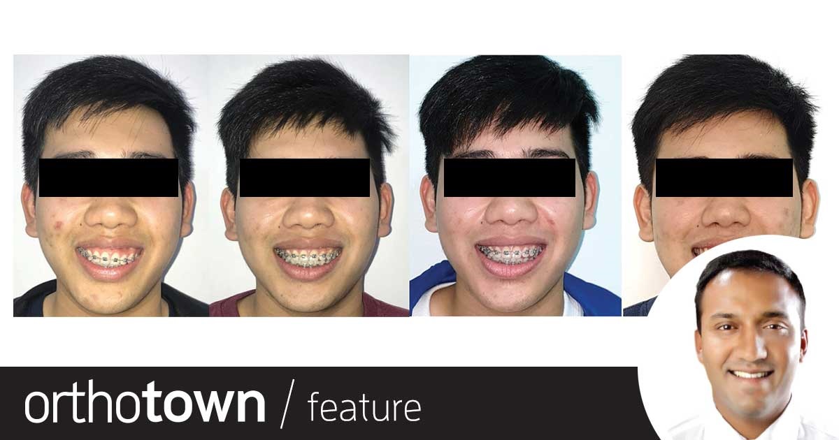 Townie Treatment Case: Can't Be Tamed In the debut installment of this new recurring feature—in which Townies walk readers through the steps of an interesting patient treatment case—Drs. Adith
Venugopal and Anand Marya share a case in which they used TADs to correct a patient’s steep occlusal cant.