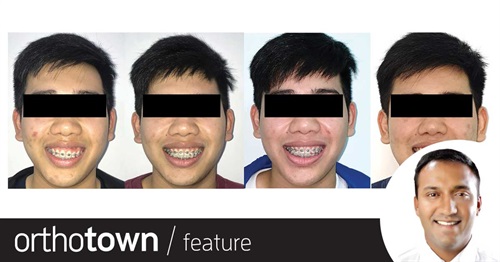 Townie Treatment Case: Can't Be Tamed In the debut installment of this new recurring feature—in which Townies walk readers through the steps of an interesting patient treatment case—Drs. Adith
Venugopal and Anand Marya share a case in which they used TADs to correct a patient’s steep occlusal cant.