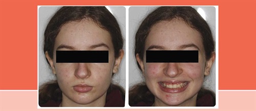 A Voice in the Arena: Lip Trapping Dr. Chad Foster, Orthotown’s editorial director, discusses how lower lip trapping can mask underlying hard-tissue deficiencies, and how to approach such cases.