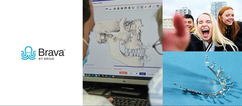 Product Profile: Brava Independent Movers System Bringing transformative technology to orthodontics