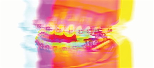 Efficient, Effective Herbst Treatment Dr. Mike DePascale discusses how he simplifies orthodontic treatment in his practice by using Herbst appliances.