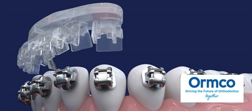 Product Profile: Ormco Digital Bonding Elevate your orthodontic practice