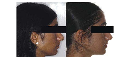Bite Turbos Meet Outside-In Aesthetics Orthotown editorial director Dr. Chad Foster provides a case presentation with a conscientious approach.