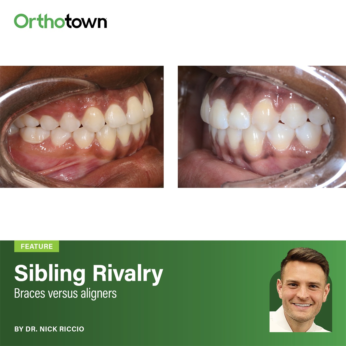 Sibling Rivalry Dr. Nick Riccio compares two siblings with identical open-bite presentations, exploring the
clinical reasoning behind treating one with aligners and the other with braces.