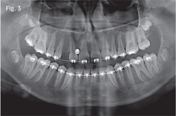 Anchors, a Way: Closing the spaces caused by congenitally missing teeth A case study featuring unusual treatment-planning from the doctors of Grady, Kastner & Gornick Orthodontics in Wexford, Pennsylvania.