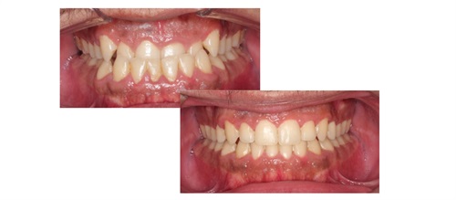 Townie Treatment Case: On the Flip Side Dr. Bilal Koleilat shares a patient case that illustrates how he treated a Class III dentoskeletal malocclusion with self-ligating braces, Class III elastics and buccal shelf TADs.
