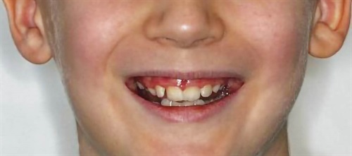 A Voice in the Arena: RPE, Caplin Hooks and Nighttime Elastics Dr. Chad Foster, Orthotown’s editorial director, discusses the use of Caplin hooks and nighttime elastics to assist rapid palatal expansion in some patients.