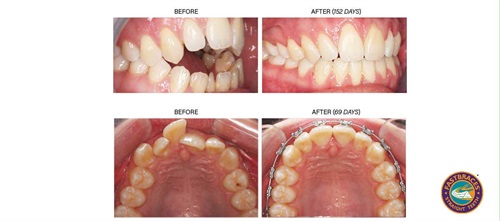 Product Profile: Fastbraces A patented method of alveolar bone restoration