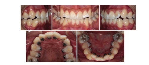 Townie Treatment Case: Sight Unseen Dr. Robert Lee shares a case study in which an adult patient opted for treatment with lingual braces, but his lingual archform initially didn’t have enough space to bond all the brackets required for treatment. 
