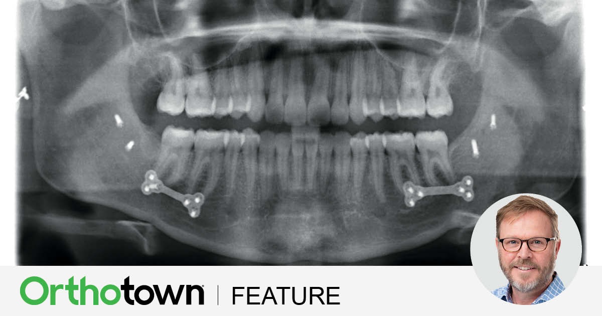 Surgical Orthodontic Treatment with Aligners