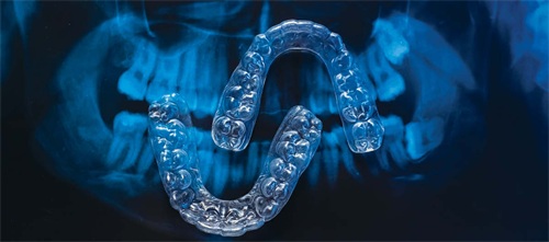 5 Proven Strategies to Improve Clear Aligner Outcomes Dr. Paola Leone shares five key strategies for reducing refinements and boosting predictability in clear aligner treatments.