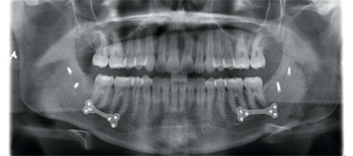 Surgical Orthodontic Treatment with Aligners Dr. Mark L. McInnis shares a complex surgical case treated with aligners that highlights planning strategies, TAD use and how surgery resolved a posterior arch discrepancy.